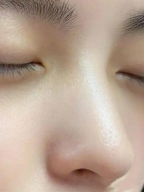 微针可以收缩毛孔吗?