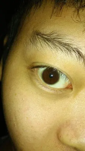 眼睛边缘发白发灰,无痛感,之前有酸涩疲劳,滴过两次滴眼露就好了,本人