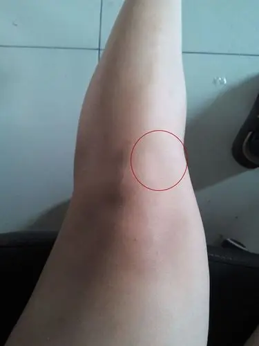 胫骨结节骨骺炎 (1)_有来医生