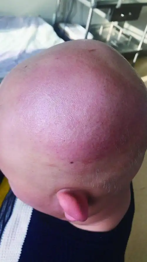 五年级男孩脱发成小光头