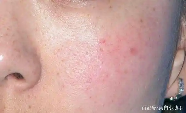 皮肤管理——脸上闭口粉刺又敏感,该怎么管理?