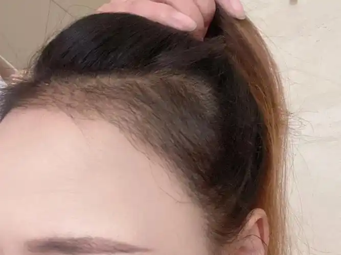 中间还是稀疏01医生说八九个月以后就正常生长建议做发际线的姐妹