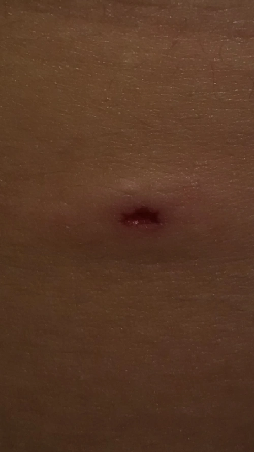 肚子上不知道是不是被虫子咬了抓破了个洞,大家来帮我看看是怎么回事