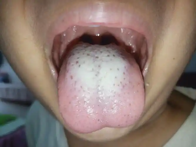 图为推拿第一天 从舌苔上,可以看到孩子脾胃区域舌苔厚腻,明显是积食