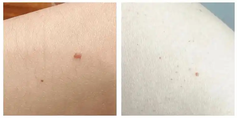 医生表示,这是血管痣,学名是樱桃样血管瘤或老年性血管瘤.