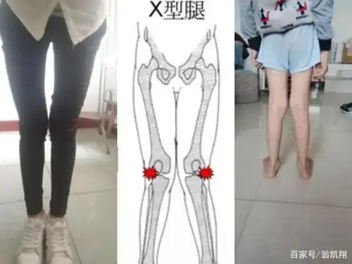 (赶紧比一下看看) 而正常的腿型