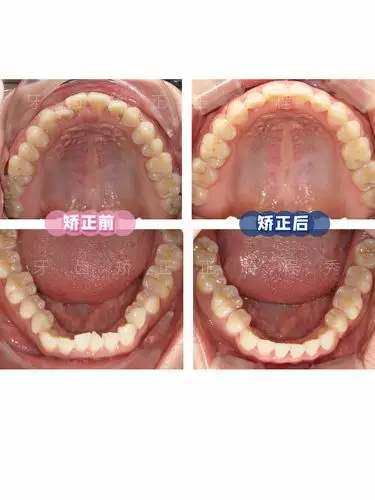 牙齿矫正前后对比 内收没有打骨钉_正畸_拔牙_牙齿正畸_美妆_医美整形