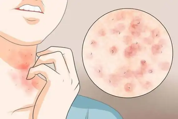 螨虫叮咬后的症状图