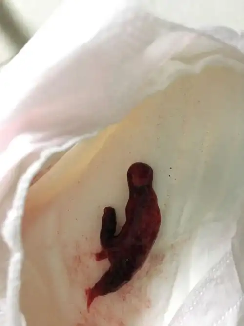 怀孕了,做b超宫内什么都没有,连续流了4天的血,今天流出一块这个物体