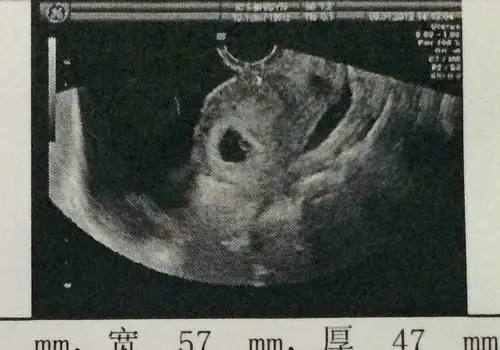 推荐回答 你好,左边圆的那个黑黑的地方处是宝宝的孕囊位置