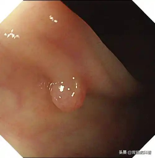 一文读懂肠息肉为啥会长肠息肉严重吗如何治疗怎样预防