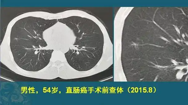 肺纤维灶是什么意思?会长成肺癌吗?该怎么办更安全?
