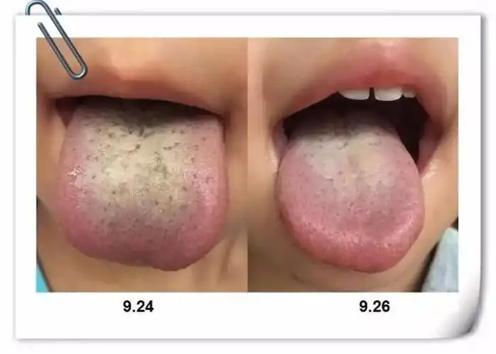 小儿舌诊临床案例—积食调理前后的舌象