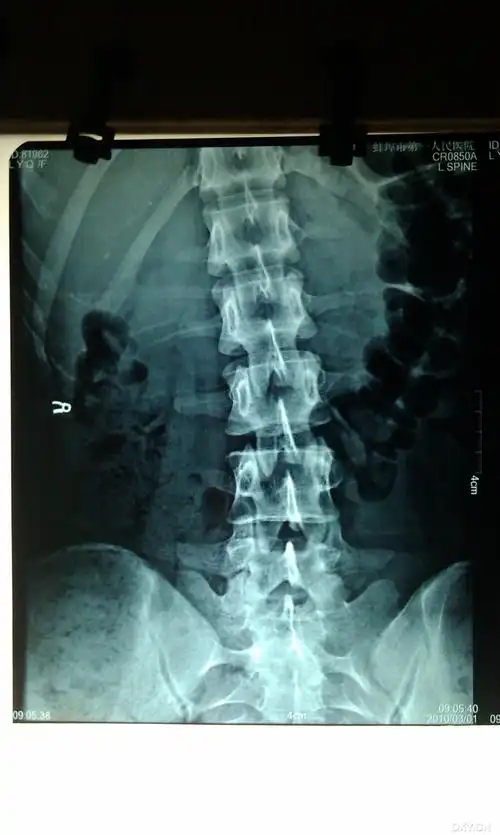 【病例讨论】脊柱侧弯 [病例帖]