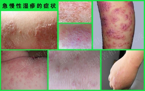 什么是湿疹图片