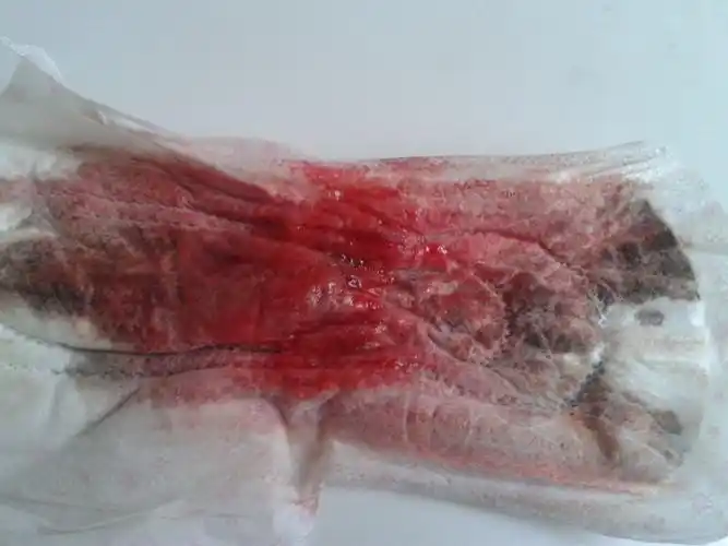 月经总是不规律的延期,都快一年了.且经血中常带有黑色斑块儿(如图),