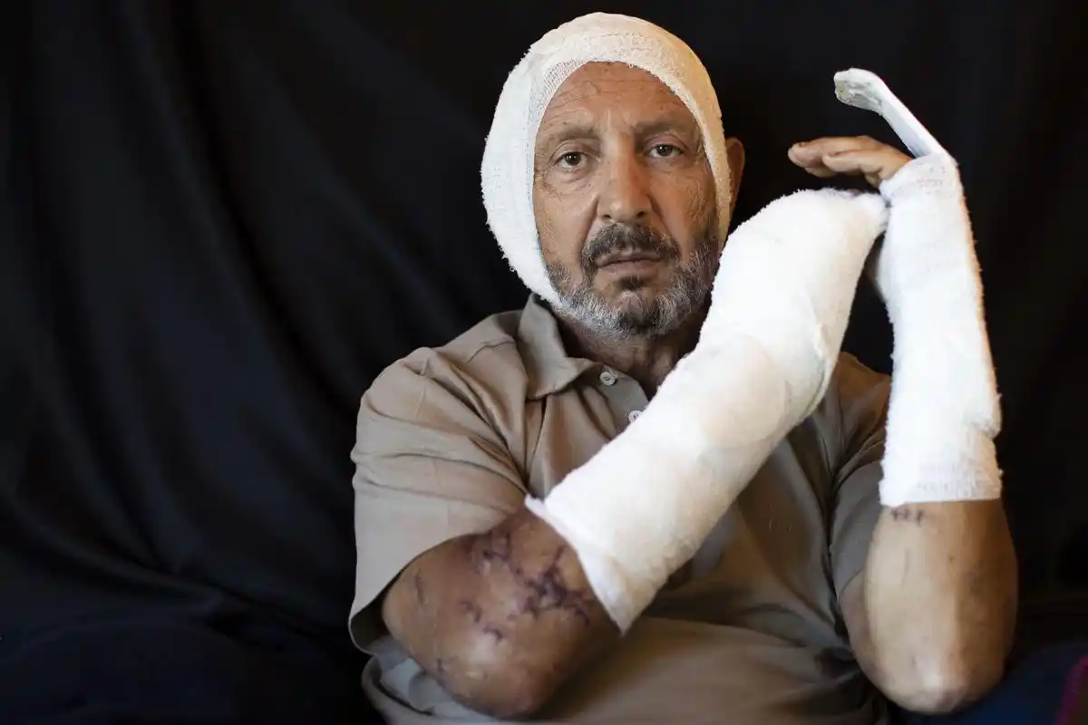 有人缝了350针,女模特也破相!黎巴嫩爆炸受害者用脸描述灾难!