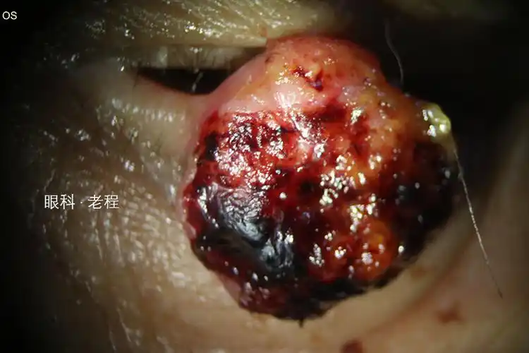 眼睑恶性肿瘤系列之鳞状细胞癌_鳞状细胞癌_鳞状细胞癌介绍 - 好大夫