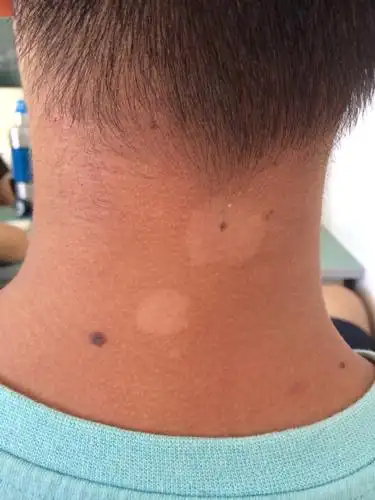 是白癜风么 急!