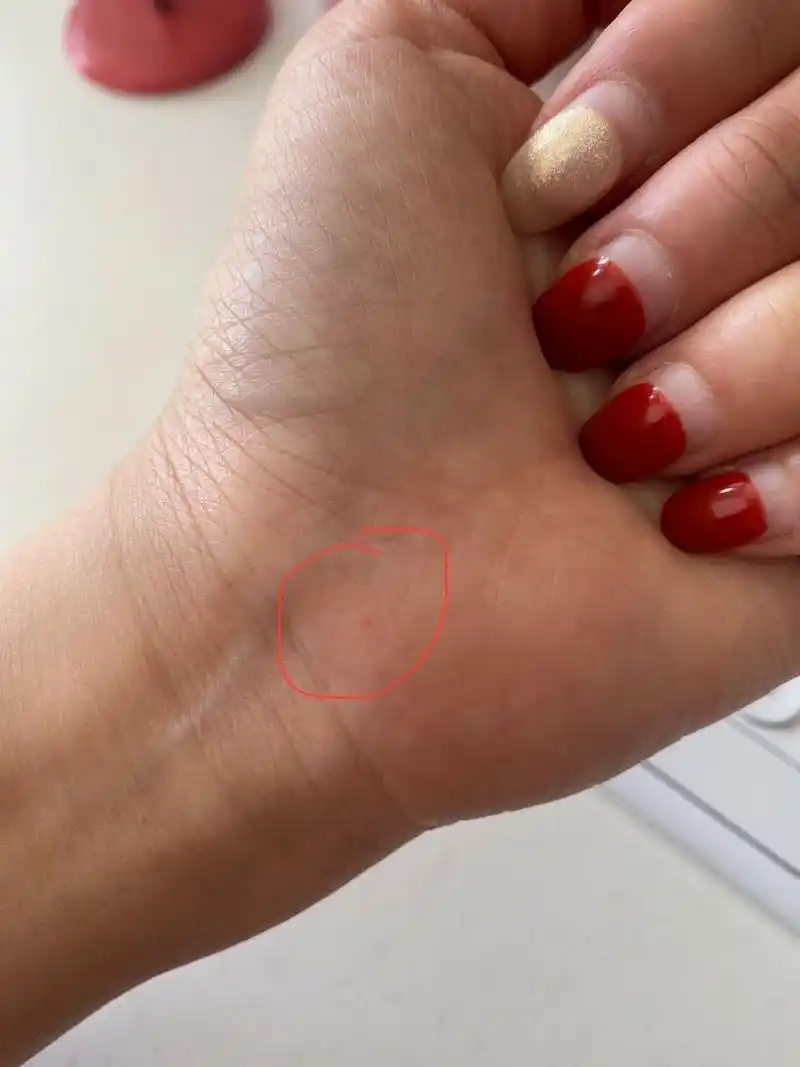 原来朱砂痣是真实存在的… 这个小红点长了几年了 起初我以为是不