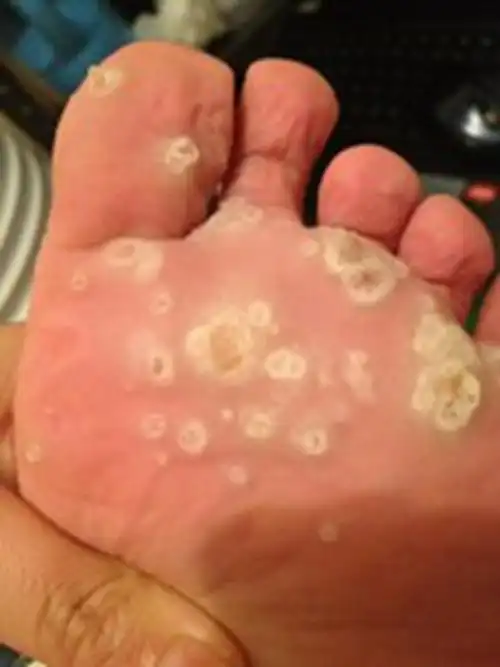 丝状疣的对比图片