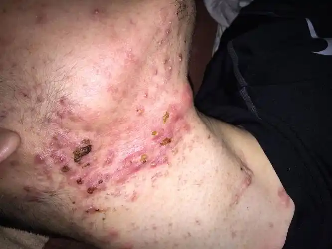 这毛囊炎还是痤疮.喝中药中,能和西药一起吃治疗吗