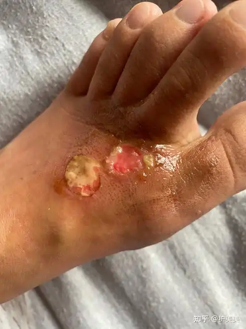 脚面烫伤恢复过程,有同样类似经历的,请进,请指导