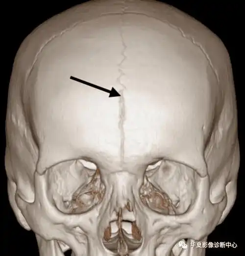 五,缝间骨缝间骨为位于颅缝间的多余骨块,多位于颅骨矢状缝和人字缝