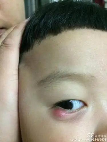 您好,我家宝宝麦粒肿有半个月了没有用过药,麻烦您帮我看看有必要去