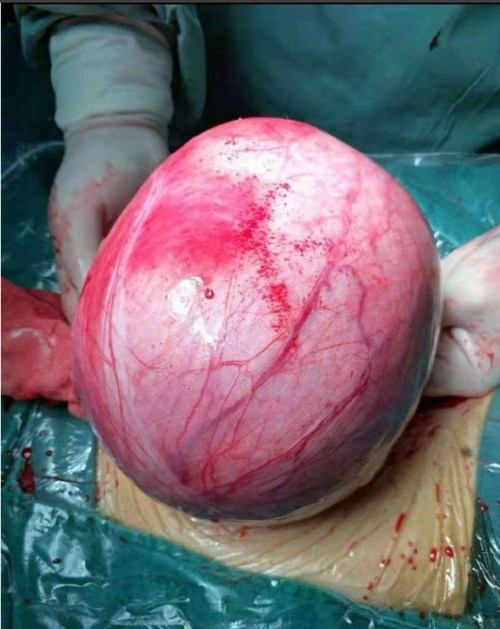 子宫肌瘤16.7×15.5×10.5cm大小,有多重?