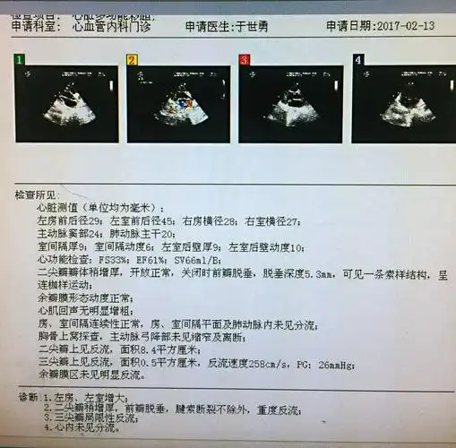 二尖瓣关闭不全是直接换瓣还是先考虑成形修复