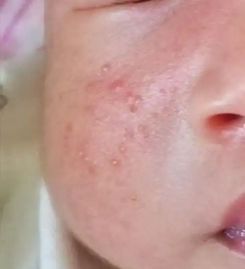 新生儿痤疮_痤疮_症状表现_治疗方式 - 好大夫在线