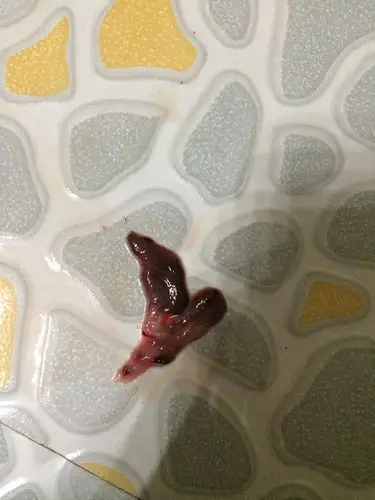 出血,现在上厕所排出这样东西,是血块还是孕囊.