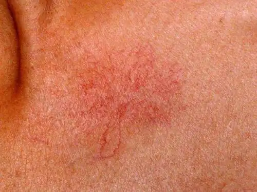 肝硬化|肝癌|肝病|乙肝|出血_网易订阅