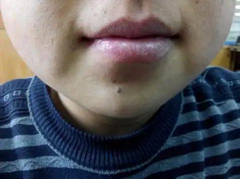 下巴长痣的位置(下颚与脖子交界处有痣的寓意)