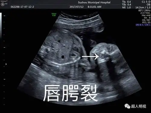 从胎儿解剖看腭裂诊断