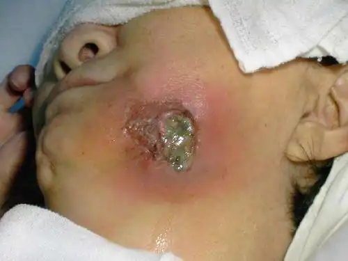 牙龈癌早期症状图片(2)