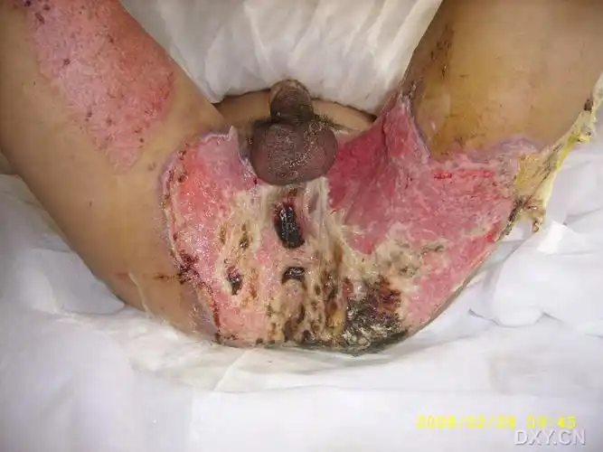 【讨论】会阴深度烧伤? [病例帖]