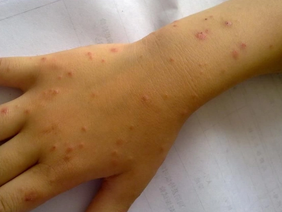 女性湿疹症状图片 (3)_有来医生