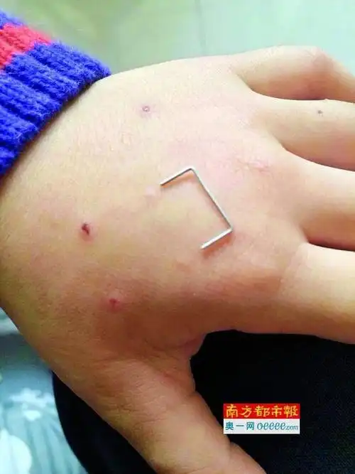 男童遭老师针扎 左手手面可见四个孔状伤痕曾谎称是蚊子咬