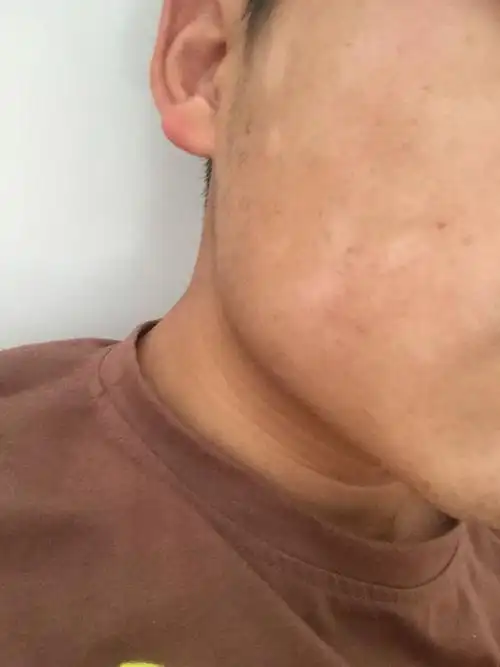 脸颊一块一块白白的斑是什么,只有脸颊上才有,是汗