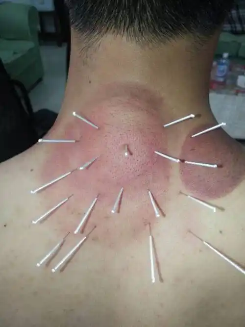 颈椎病针灸能治好吗?