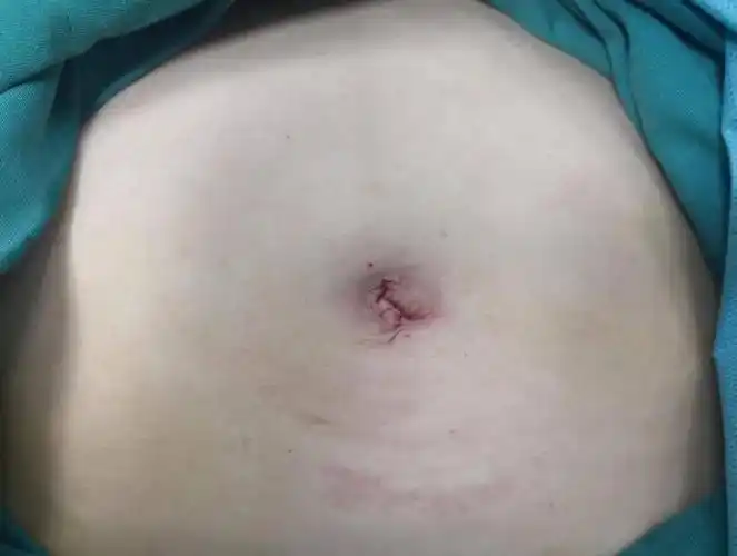 在这家医院做了子宫全切手术居然无疤