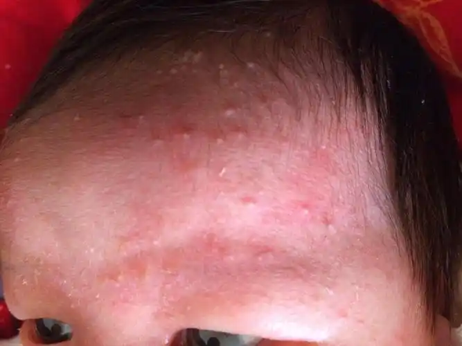 20多天的婴儿,头上起了好多小泡.