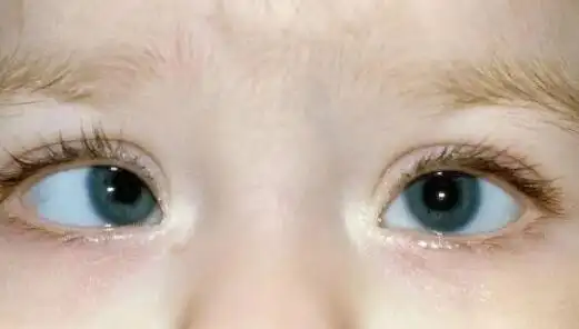 儿童斜视的典型体征是眼位偏斜,表现为复视,眼疲劳,畏光,视物模糊等.