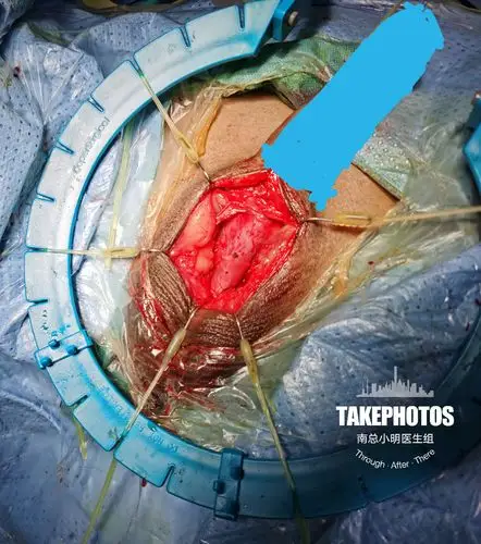 2020年华南地区第一例人工尿道括约肌植入手术成功! - 好大夫在线