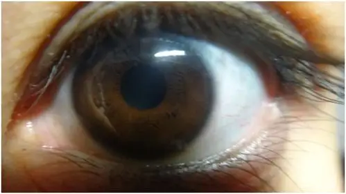 视力科普之散瞳后需注意事项