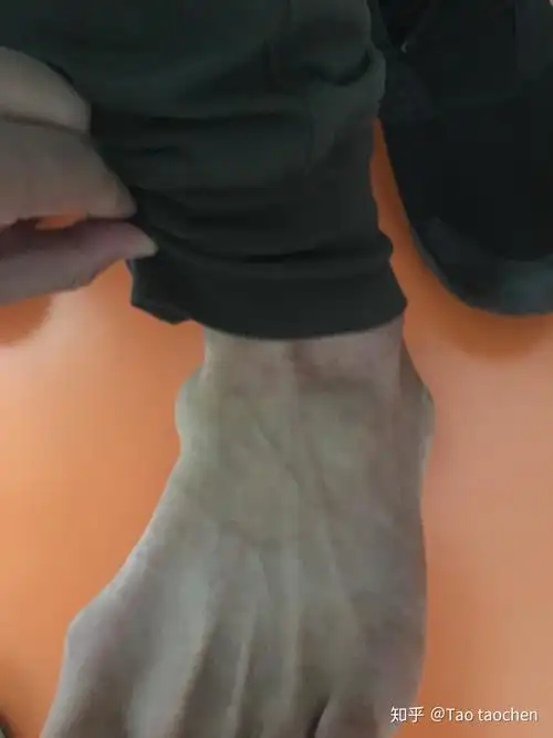 踝关节滑膜炎并积液肿胀天津艾柯特运动康复中心案例分享