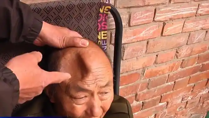 2017年河南老人住养老院仅20天头顶凹个大坑养老院与我无关