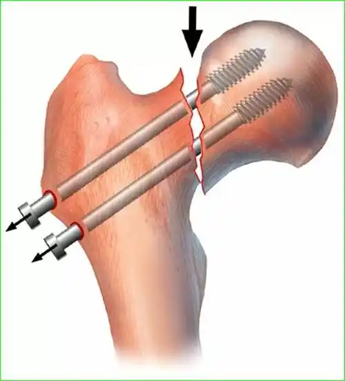 有关空心钉治疗老年股骨颈骨折的疗效评价